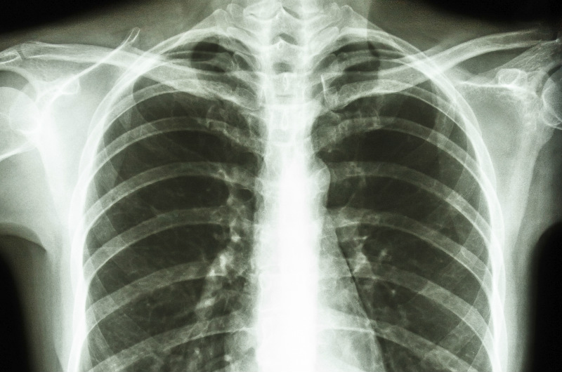 Chest Xrays Before Surgery When you need them and when you don’t